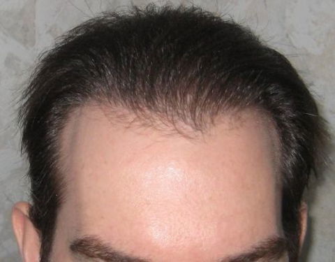 Hair Transplant Abroad - Sydney Hairdressers 3