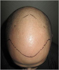 Hair Transplant Abroad - Sydney Hairdressers 5